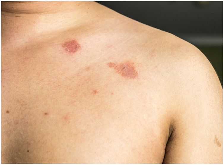 Butenafine Hydrochloride vs Clotrimazole for Jock Itch and Ringworm