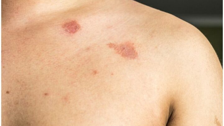 Butenafine Hydrochloride vs Clotrimazole for Jock Itch and Ringworm – Uses & Side Effects