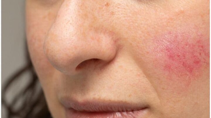 Redness Around Nose, Mouth, Chin, Cheeks, Eyes – Causes & Remedies