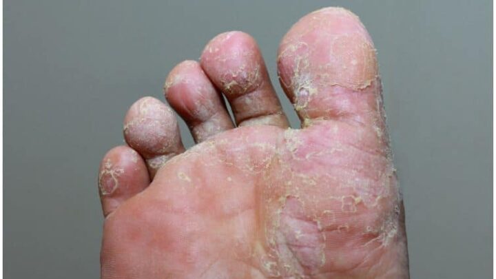 Tolnaftate vs Clotrimazole For Athlete’s Foot, Ringworm, Jock Itch - Uses