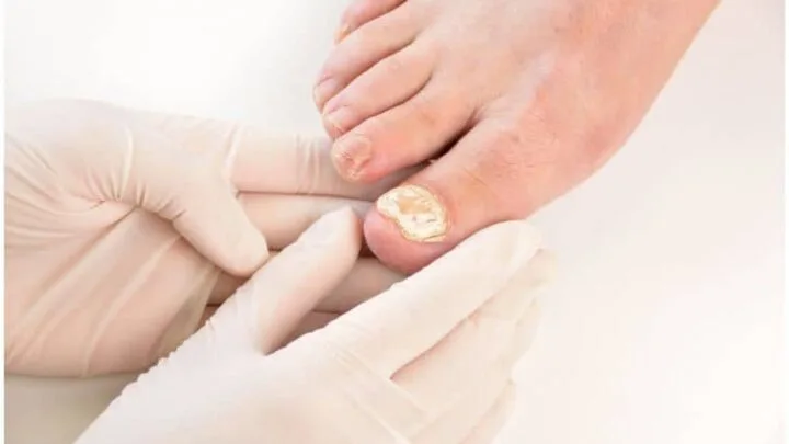 Kerydin vs Jublia For Nail Fungus – Cost & Effectiveness + Alternatives