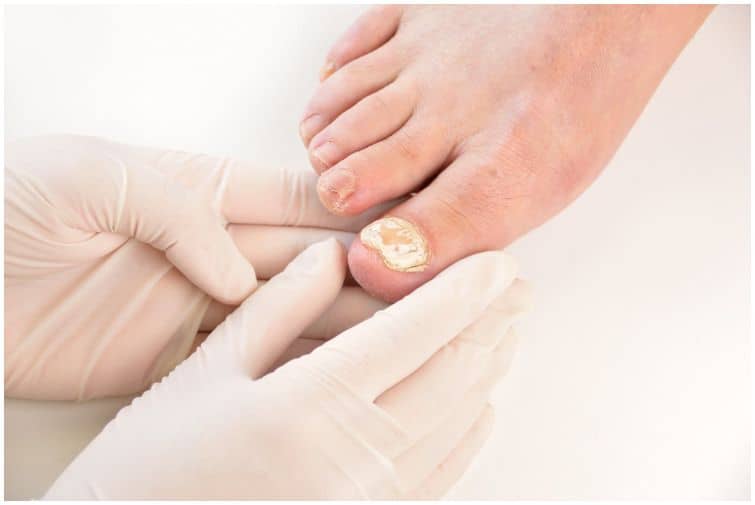 Kerydin vs Jublia Health Guide Net