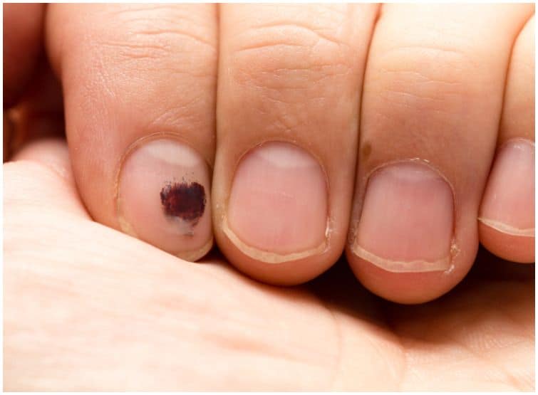 Subungual Hematoma Vs Melanoma Differences Health Guide Net