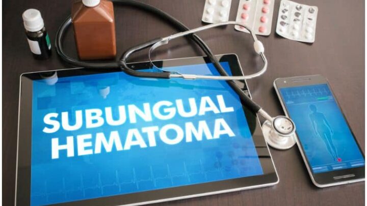 Subungual Hematoma vs Melanoma – Differences