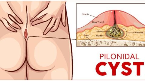 Pilonidal Cyst – 10 Natural Cures (Without Surgery)
