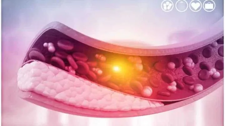 20 Interesting Facts About Atherosclerosis + Statistics & Causes