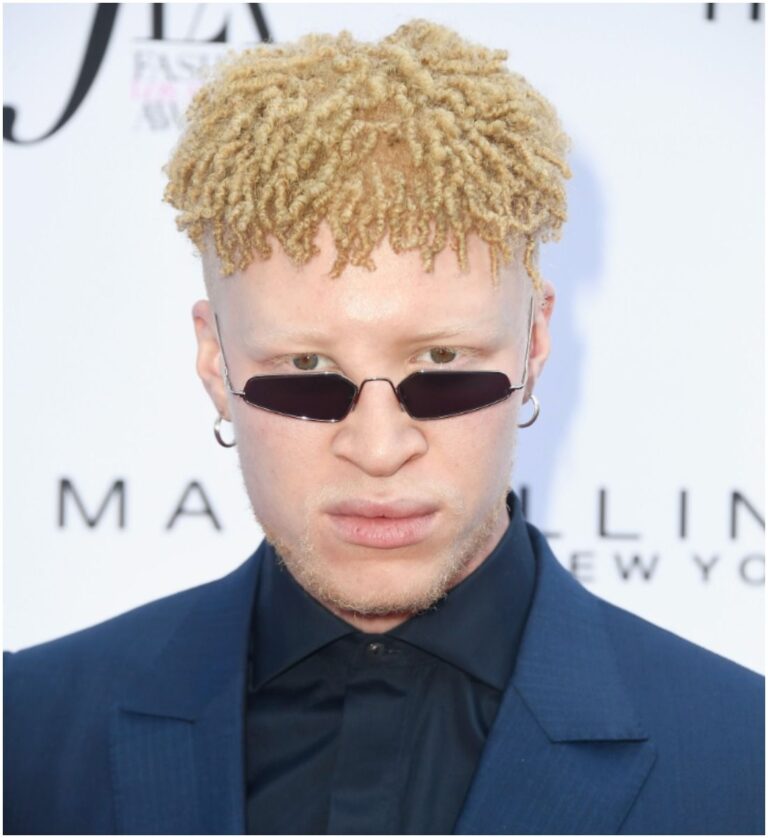 Famous People with Albinism - Health Guide Net