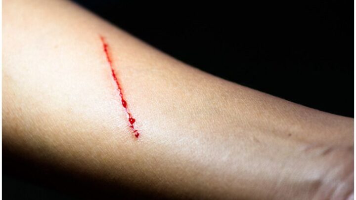 Bacitracin vs Mupirocin (Bactroban) – Which Is The Best Ointment For Wound Healing?