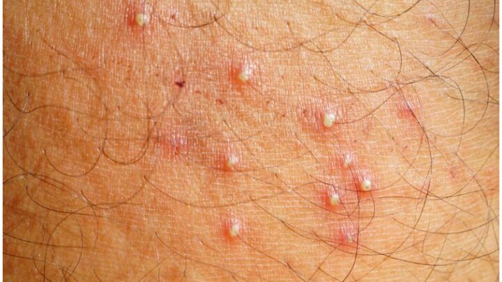 Folliculitis vs Herpes - Symptoms, Causes, Pictures, Differences
