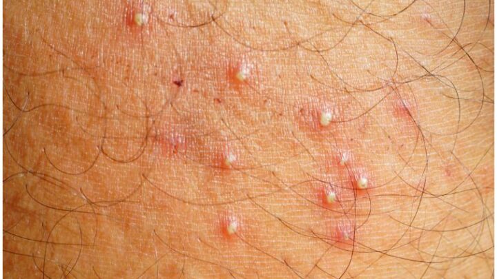 Folliculitis Vs Herpes Symptoms Causes Pictures Differences Health Guide Net