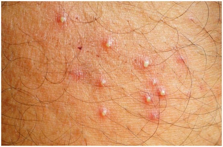 Folliculitis Vs Herpes Symptoms Causes Pictures Differences 