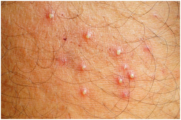 Does Herpes Cause Bumps All Over Your Body